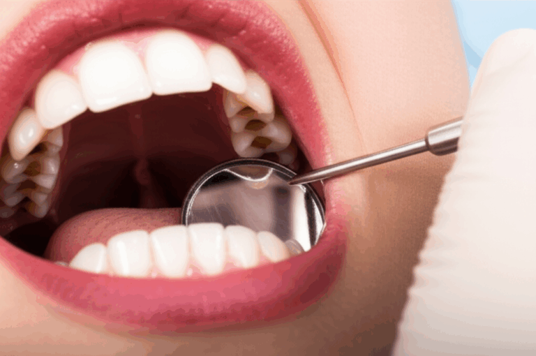 Can a Dentist Fill a Cavity Between Teeth Absolutely Here s How