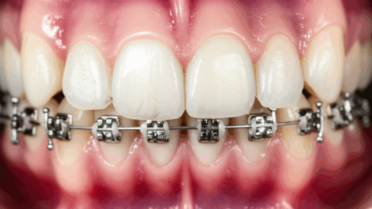 Can a Dentist Fix a Broken Bracket And Your Next Steps