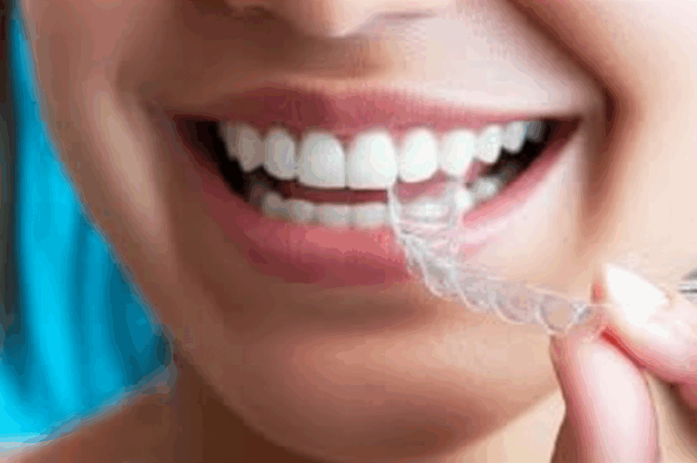 Why Dentists Recommend Invisalign Clearing Up the Push