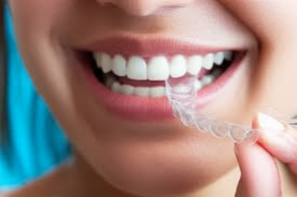 Why Dentists Recommend Invisalign Clearing Up the Push